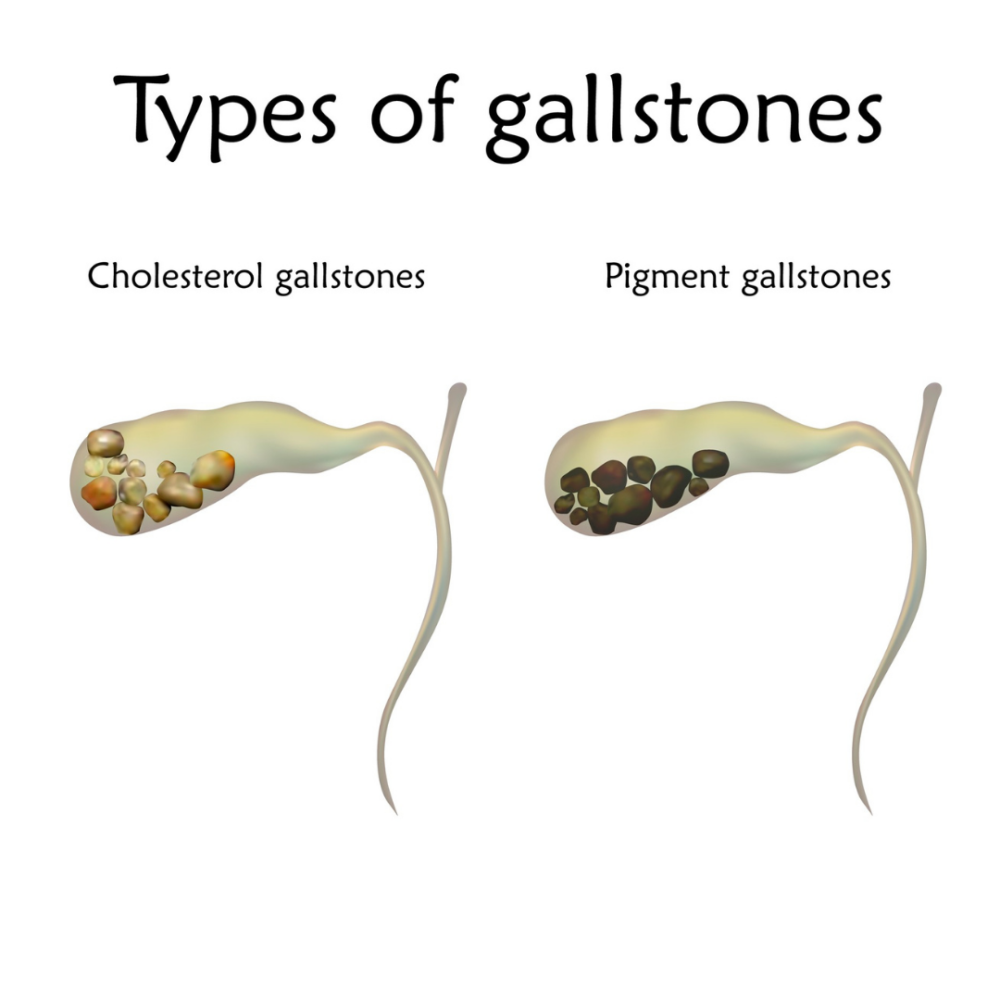 Gallstone deals in stool